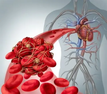Qu’est-ce qu’une embolie pulmonaire ?